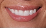 Photograph of smile, dentist Minden, NE